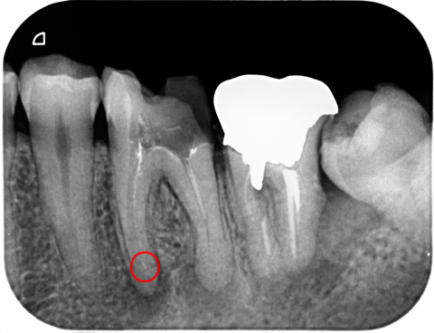 歯根 膜 炎 レントゲン で わかる