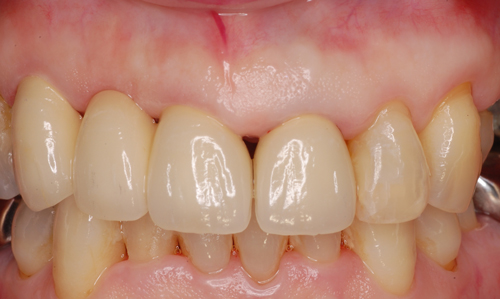 前歯のメタルボンドブリッジ（その２） | 木田歯科医院のブログ