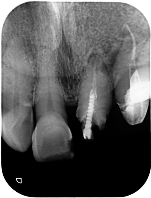 メタルセラミッククラウンで補綴した前歯の外科的歯内療法 | 木田歯科 